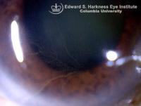 Vortex Keratopathy or Cornea Verticillata
